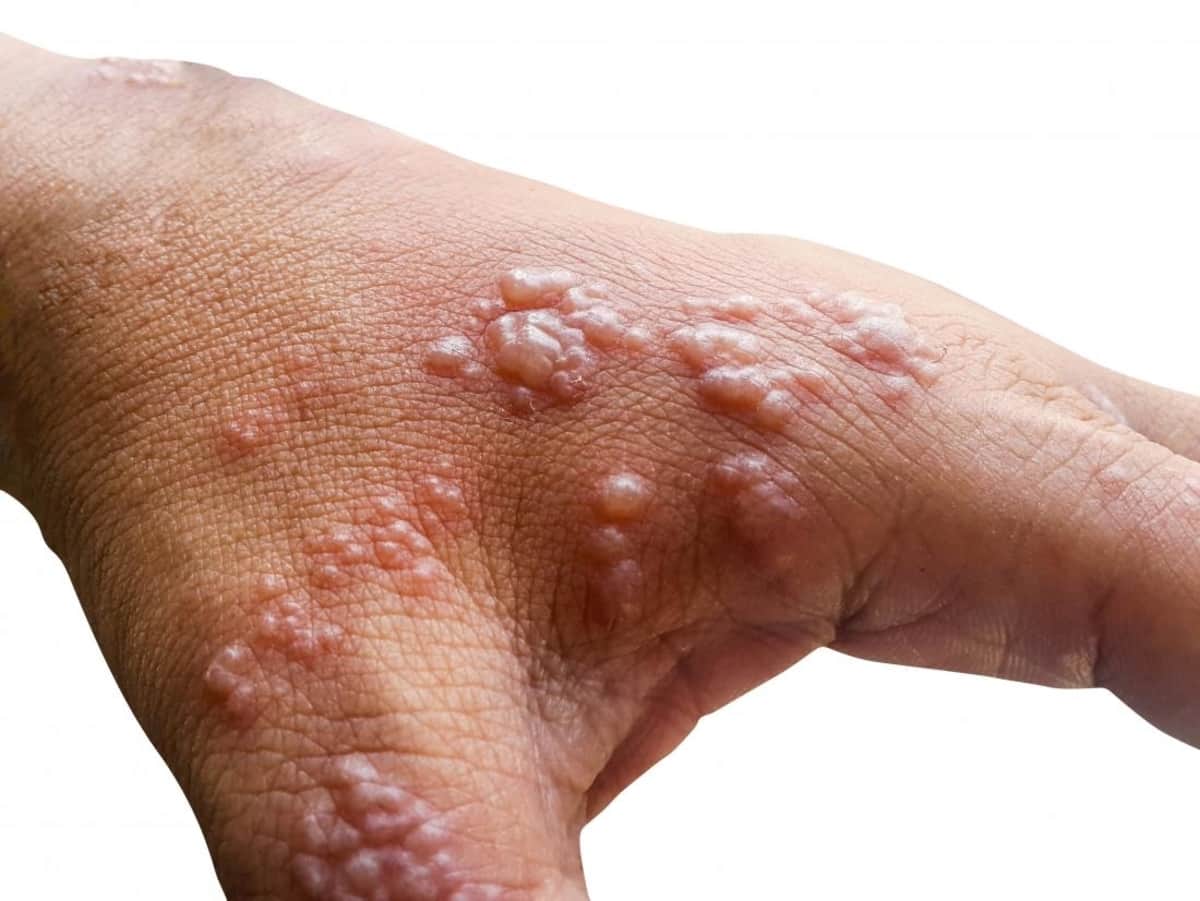 Monkeypox